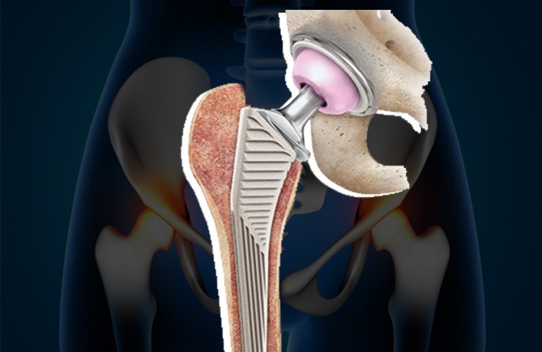 Hip revision specialist In betul