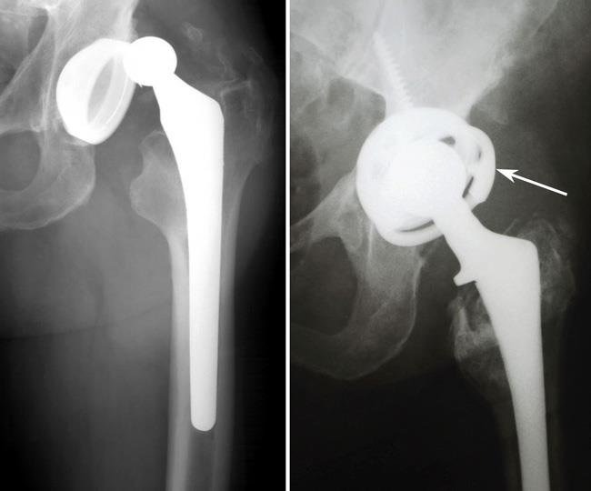 Hip revision specialist In mandla