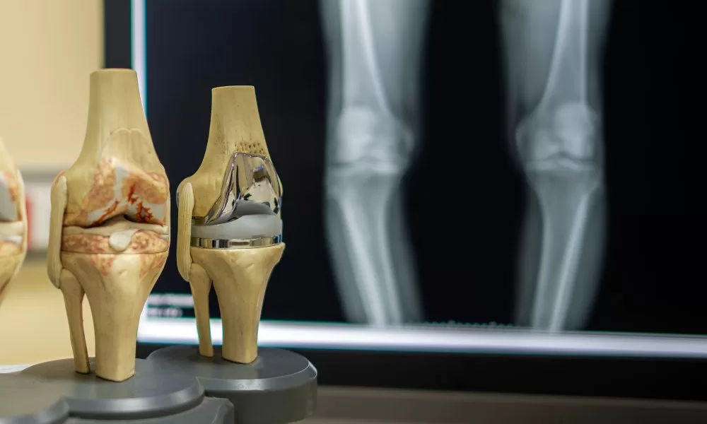 Knee replacement surgery Specialist In Nagpur