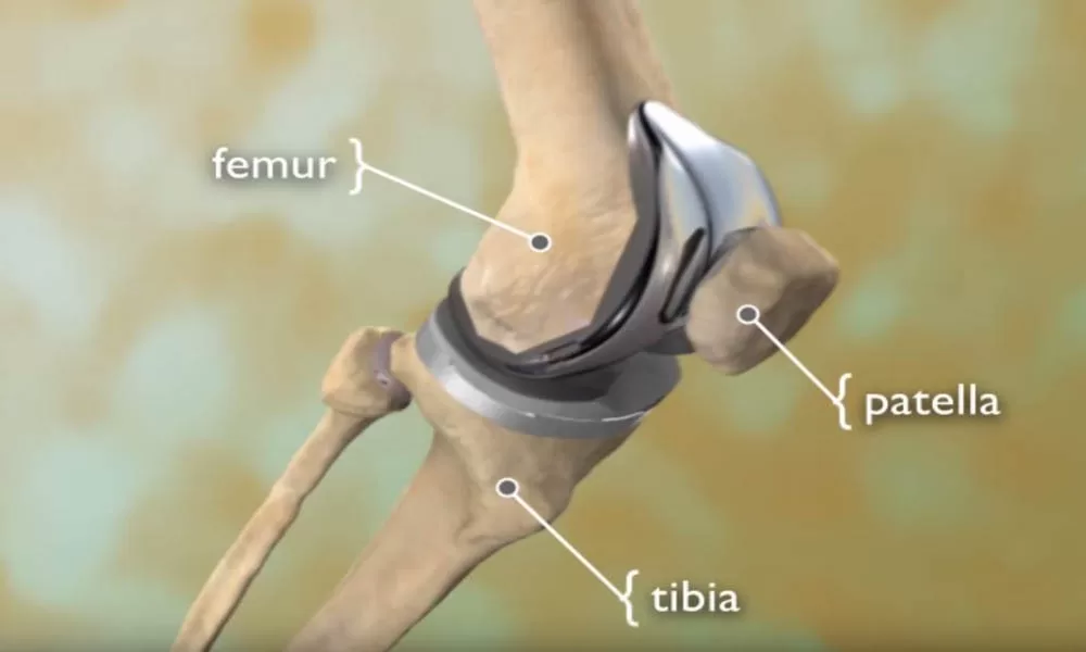 Knee replacement surgery Specialist in Seoni
