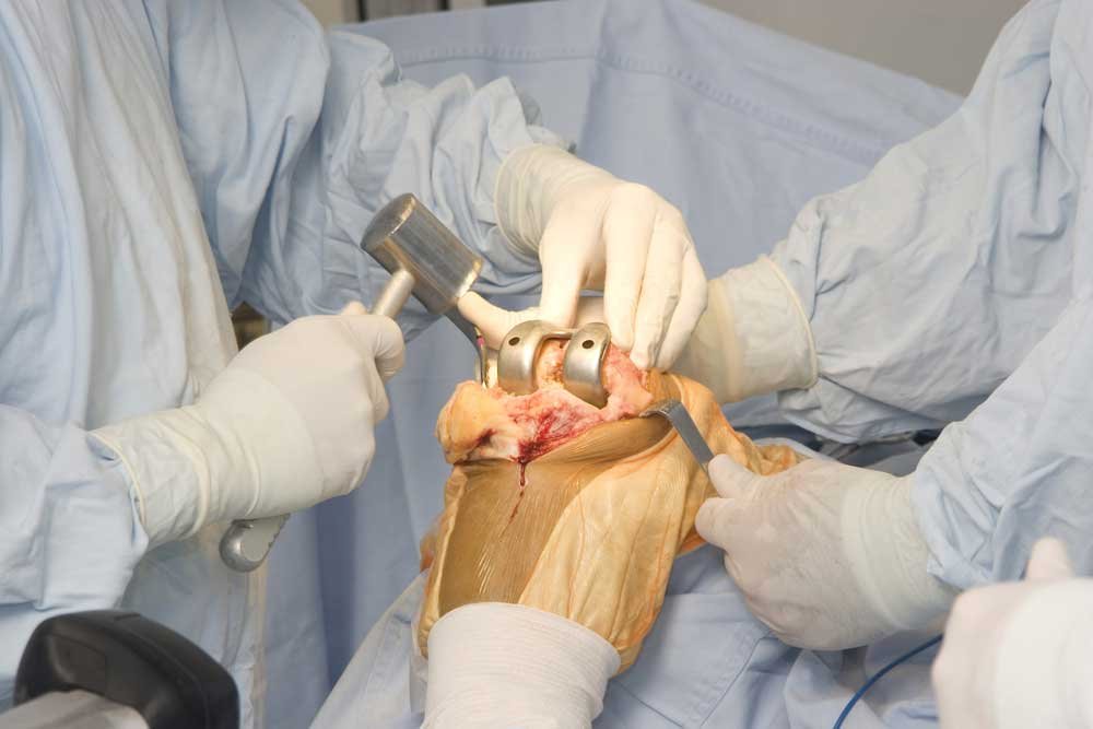 Knee revision surgeon In Betul