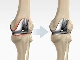 Knee revision surgeon In Mandla