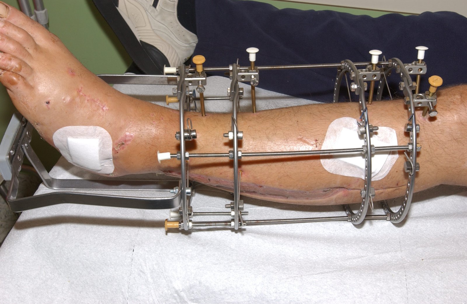 Limb reconstruction surgery specialist in Rewa