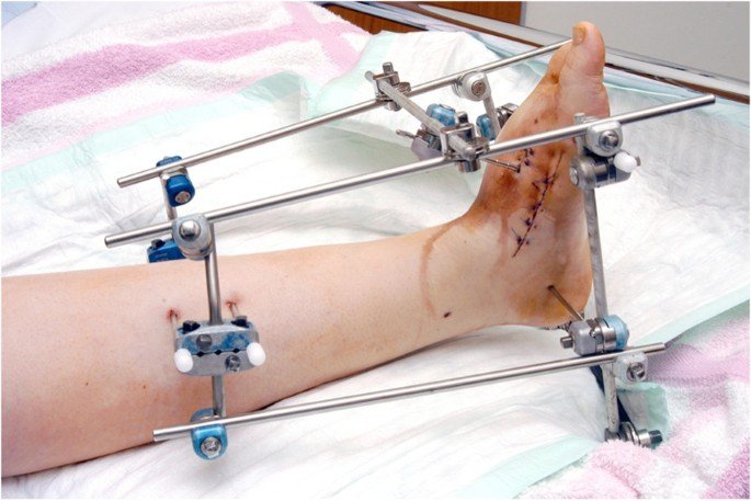 Limb reconstruction surgery specialist in Satna