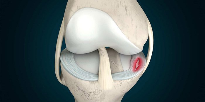 Meniscus repair surgery specialist in Itarsi
