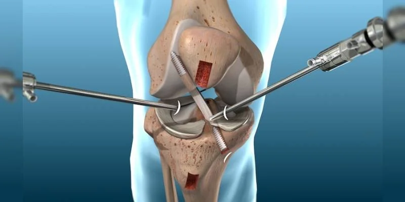 Minimally invasive knee replacement In Mandla