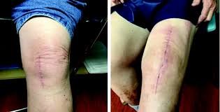 Minimally invasive knee replacement In betul