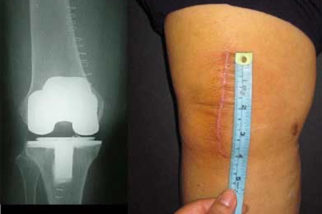 Minimally invasive knee replacement in Itarsi