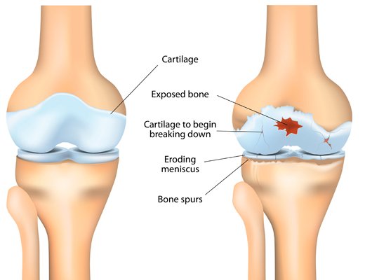Osteoarthritis knee treatment in Betul