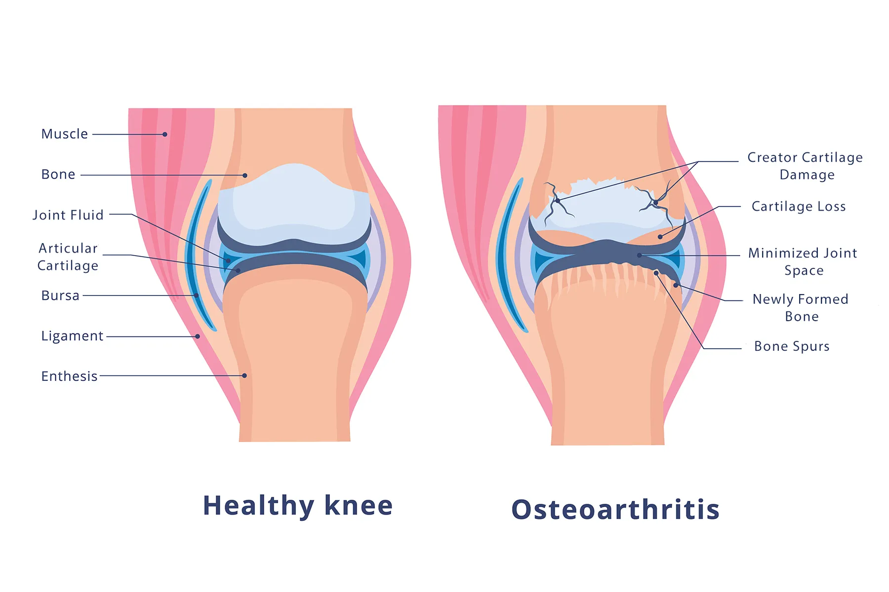 Osteoarthritis knee treatment in Itarsi