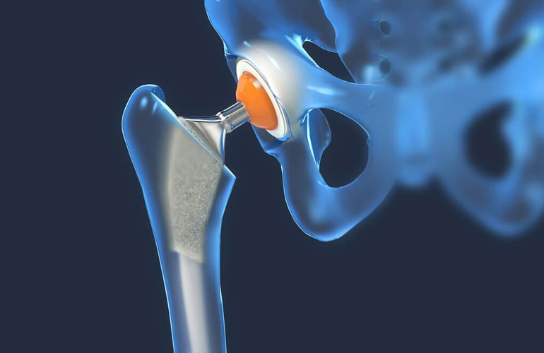 Primary hip replacement in Betul