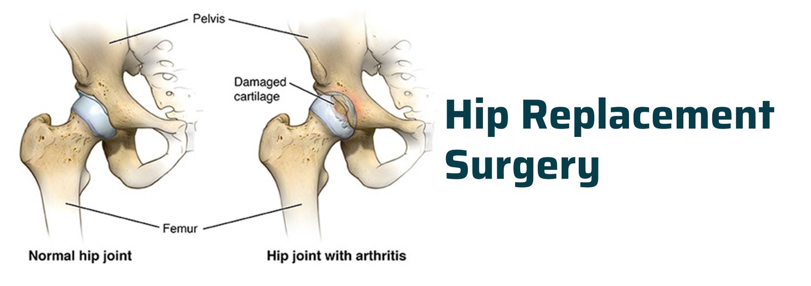 Primary hip replacement in jabalpur