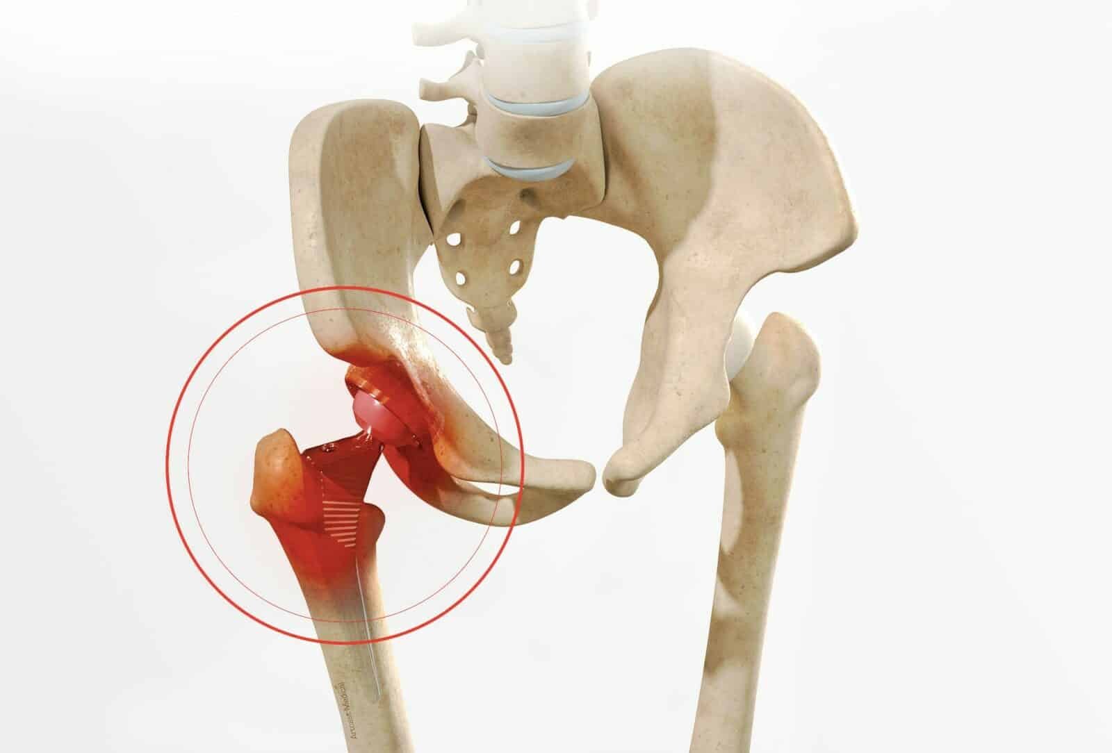 Revision hip replacement In Betul