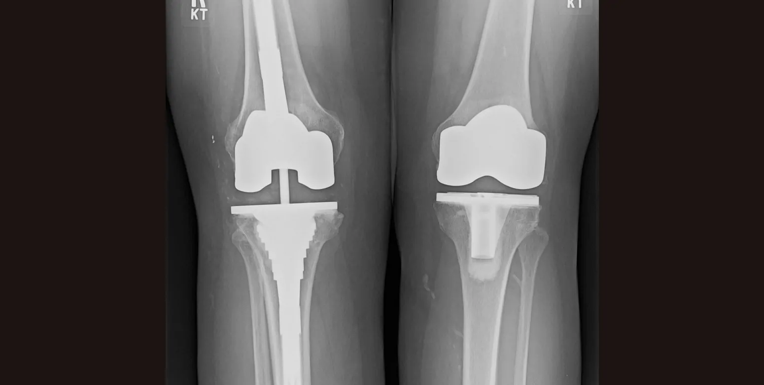 Revision knee replacement In Mandla