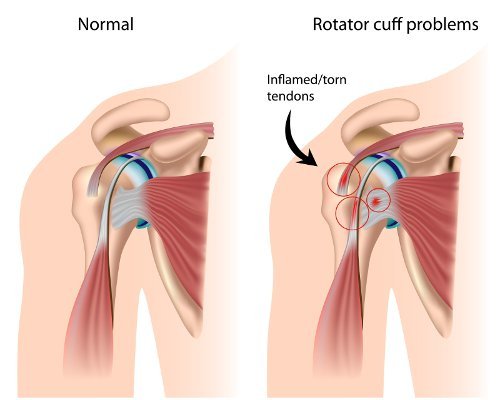 Rotator cuff tear treatment in Betul