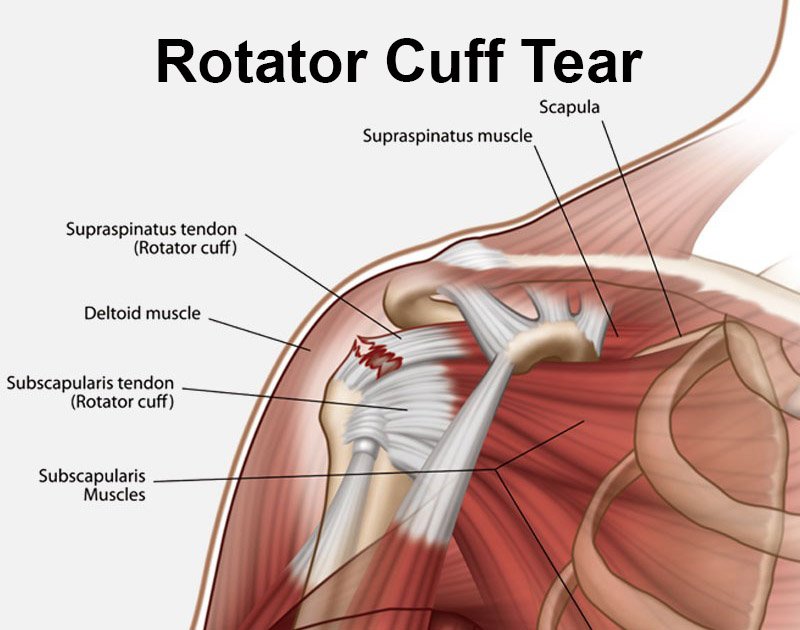 Rotator cuff tear treatment in Mandla