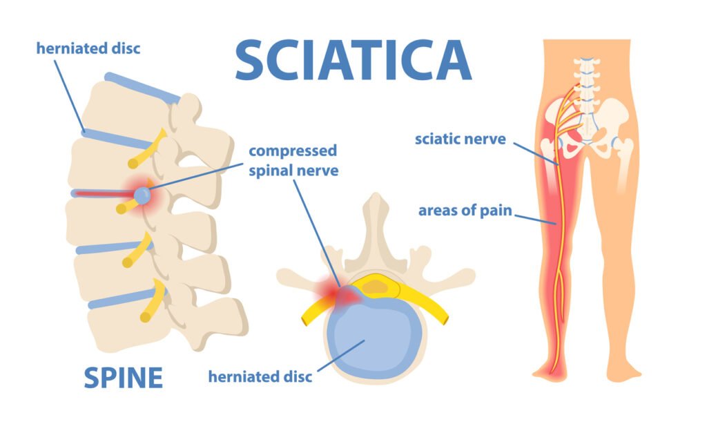 Sciatica surgery Specialist In Itarsi