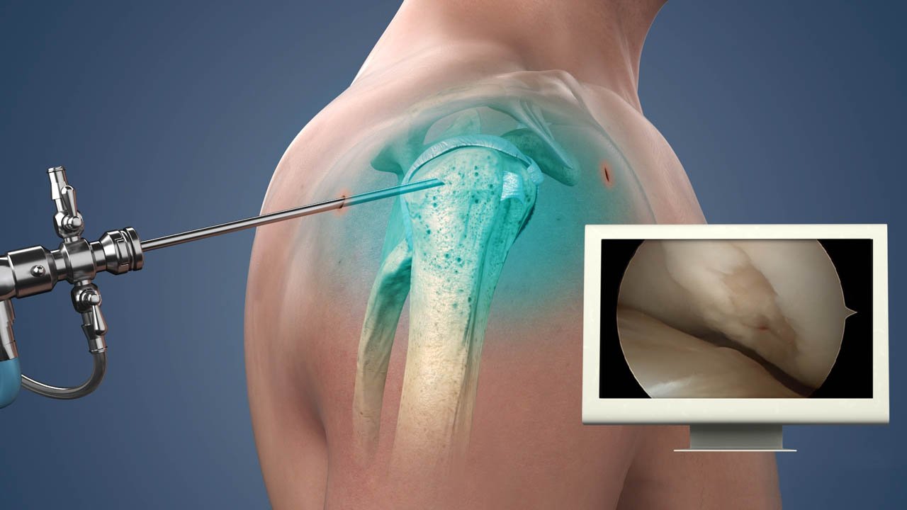 Shoulder arthroscopy in Betul