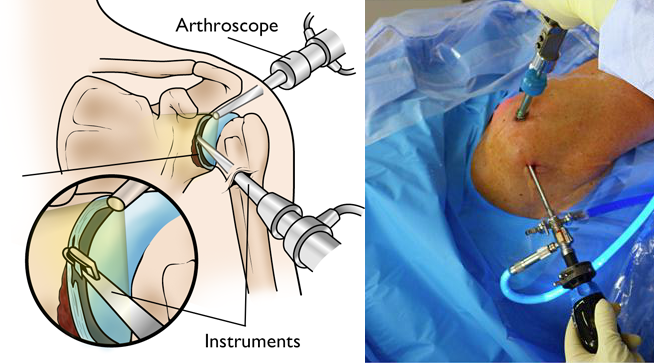 Shoulder arthroscopy in harda