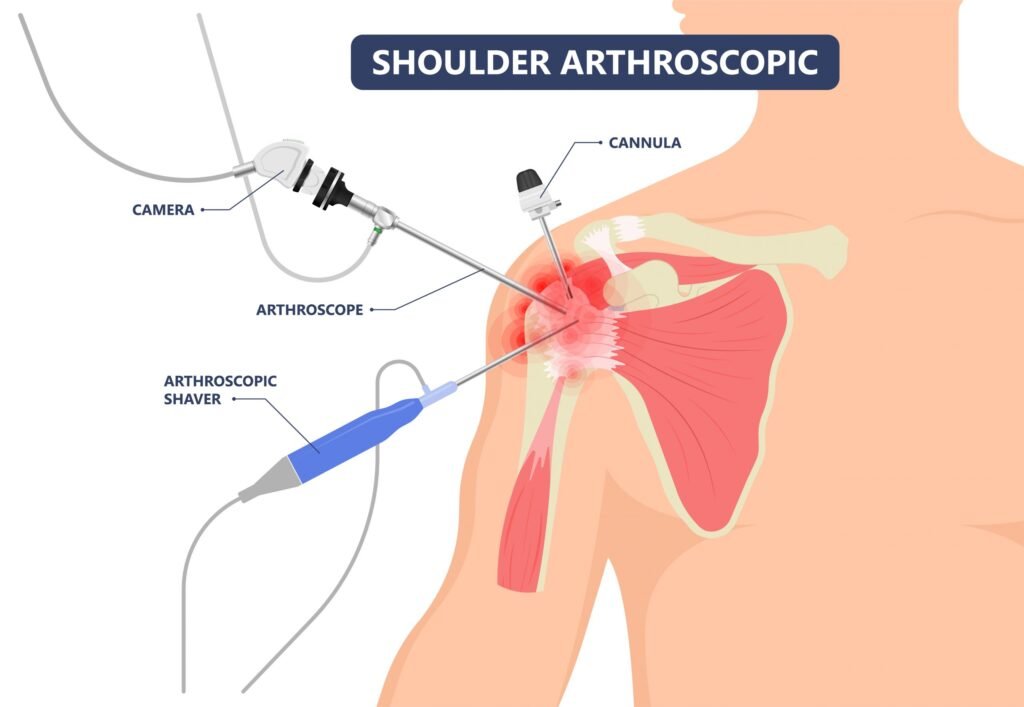 Shoulder arthroscopy in mandla