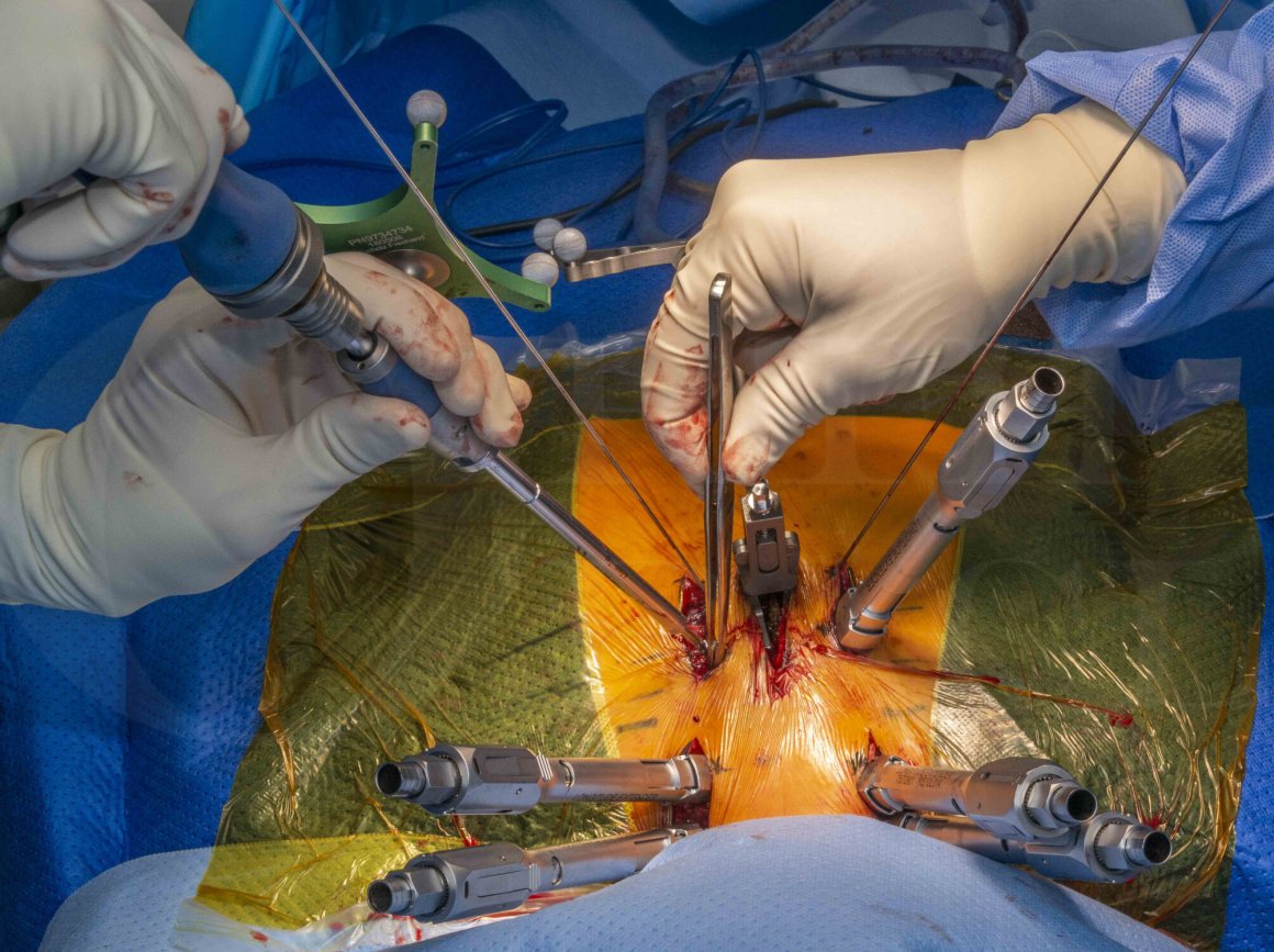 Spinal cord decompression In Betul