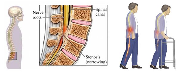 Spinal cord decompression In Itarsi