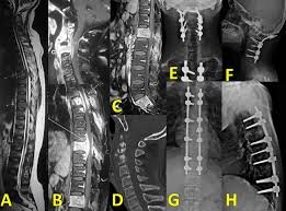 Spine fusion surgery specialist in Itarsi