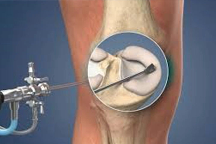 Sports injury arthroscopy In Mandla