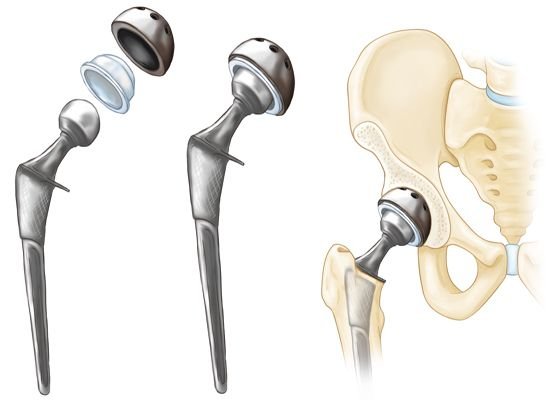 Total hip replacement (THR) in Mandla