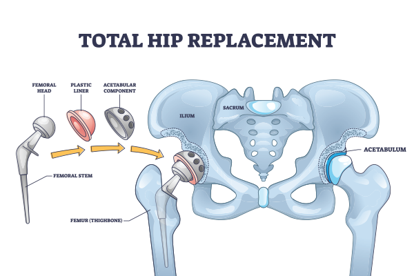 Total hip replacement (THR) in betul