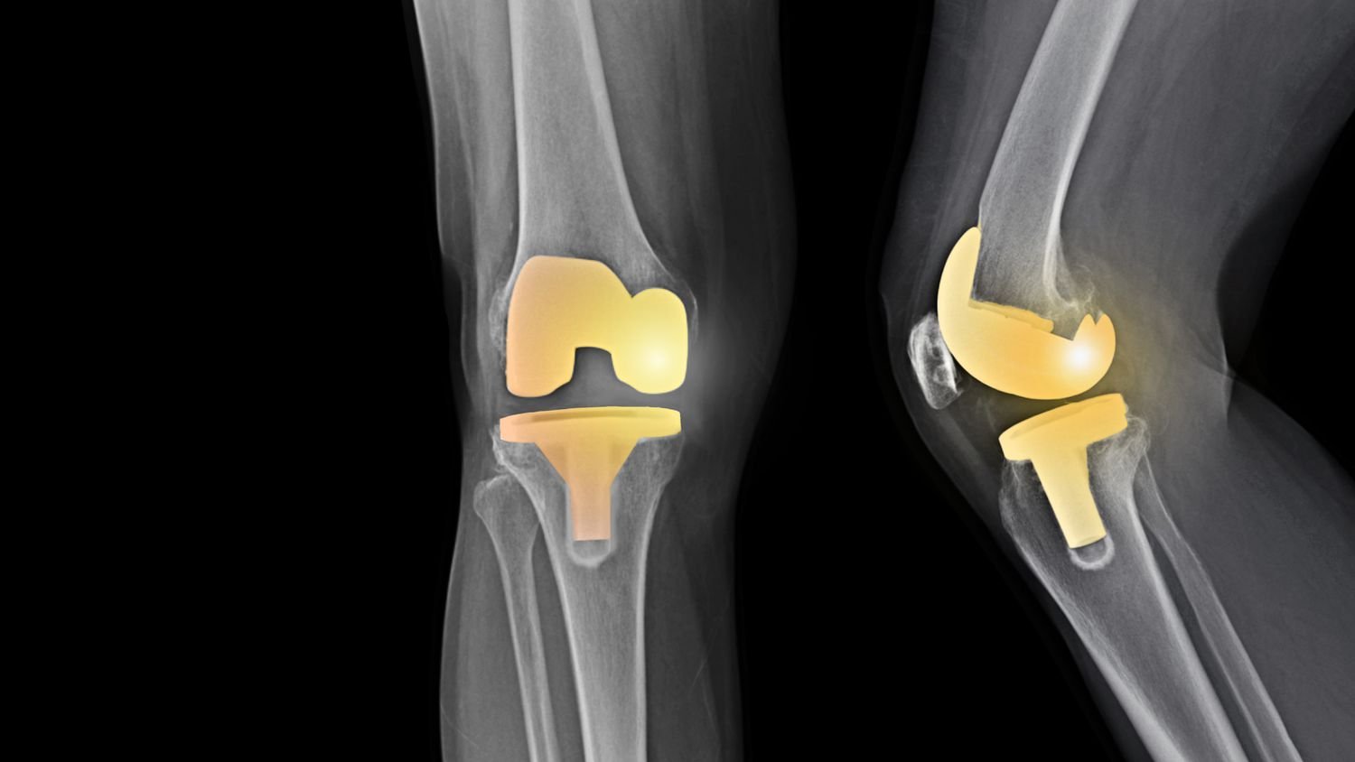 Total knee replacement (TKR) in Betul