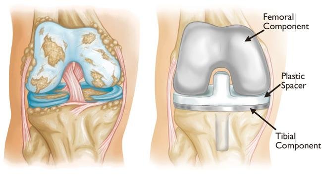 Total knee replacement (TKR) in itarsi