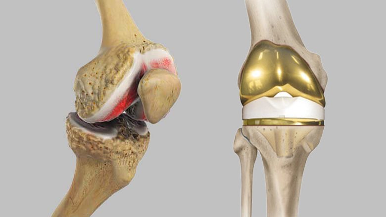Total knee replacement (TKR) in mandla