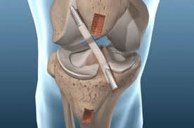 ACL reconstruction surgery specialist in Chhindwara