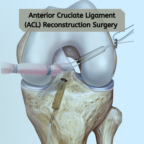 Acl reconstruction surgery specialist in adilabad