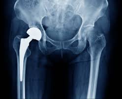 Best hip replacement doctor in Chhindwara