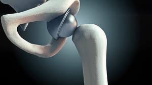 Best hip replacement doctor in Seoni