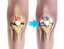 Complex knee replacement in Hoshangabad