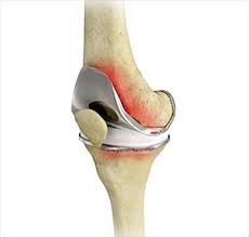 Failed joint replacement correction in Harda