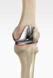 Failed joint replacement correction in Seoni