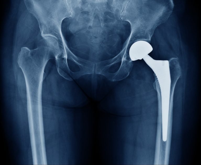 Failed joint replacement in jabalpur