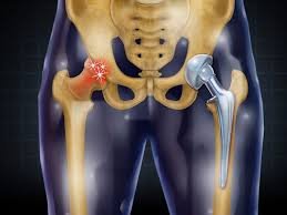 Hip Replacement Surgery Specialist in Hoshangabad