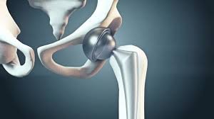 Hip arthritis surgery specialist in Chhindwara