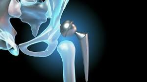 Hip arthritis surgery specialist in Seoni