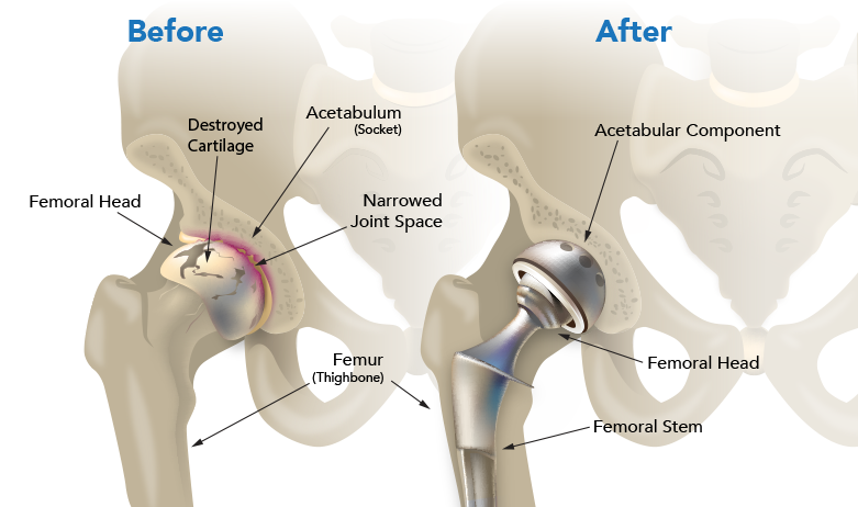 Hip replacement surgery specialist in Jabalpur
