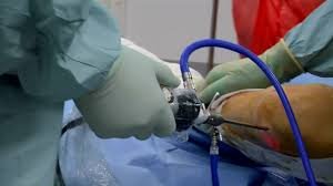 Knee arthroscopy in Chhindwara