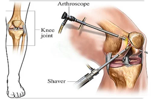 Knee arthroscopy in Jabalpur