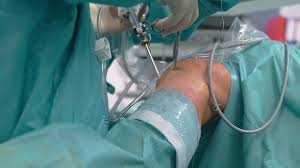 Knee arthroscopy in Seoni