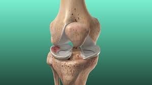 Meniscus repair surgery specialist in Chhindwara