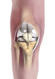 Minimally invasive knee replacement in Hoshangabad